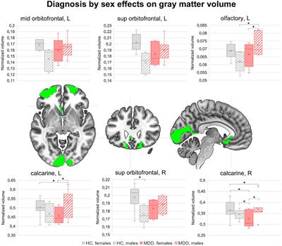 Sexual Dimorphism in the Brain Correlates of Adult-Onset Depression: A Pilot Structural and Functional 3T MRI Study